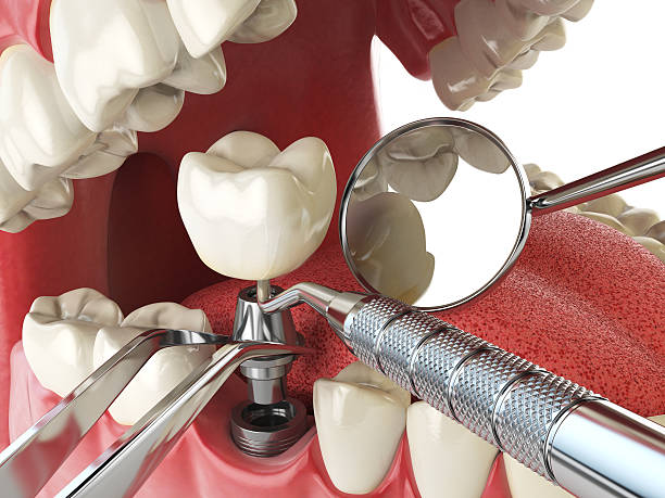 Best Emergency Root Canal Treatment in Kissimmee, FL